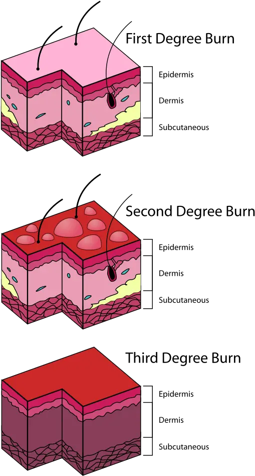 Burn Degree Diagram Three Classifications Of Burns Png Burn Mark Png
