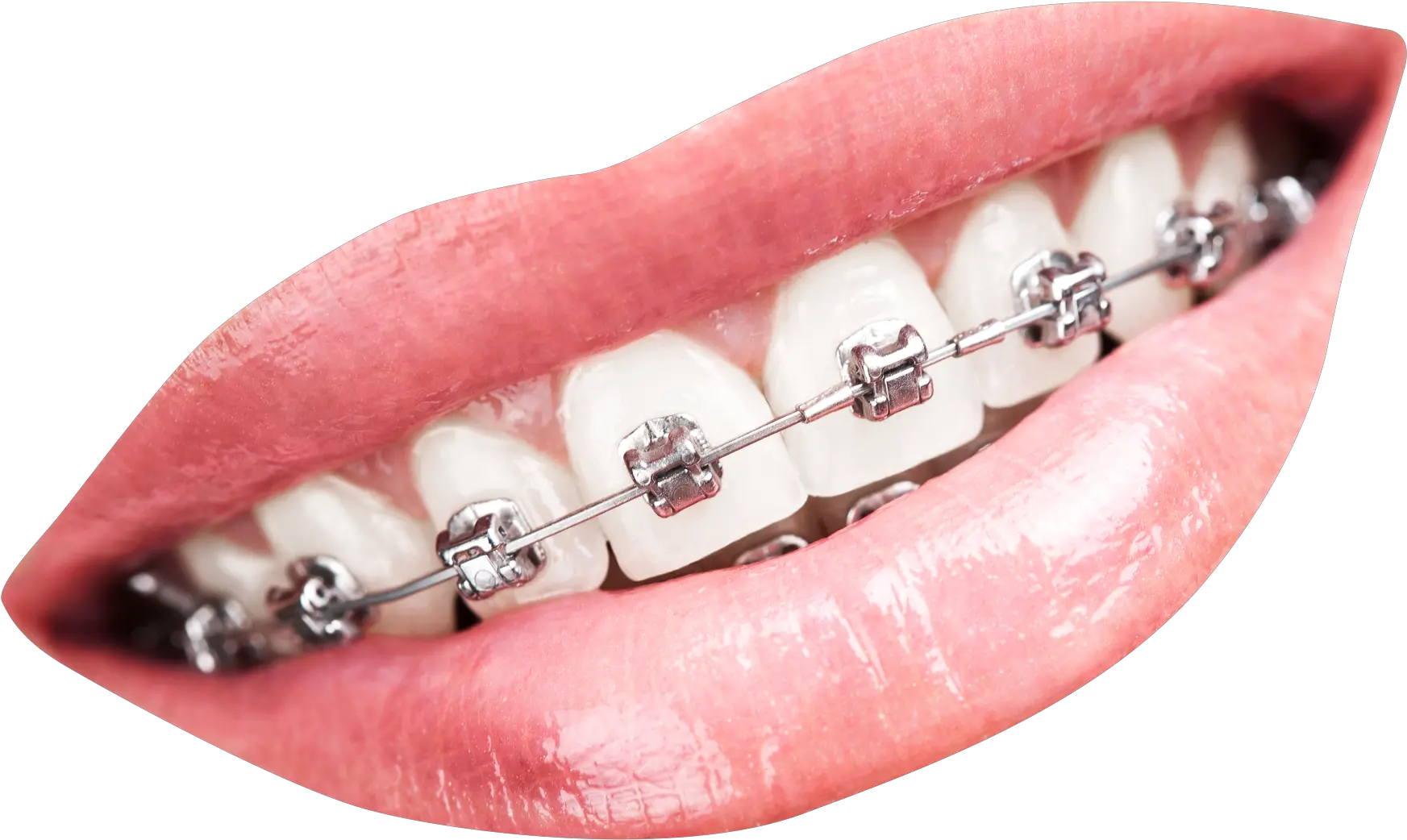 Teeth With Braces Png Transparent Image Pngpix Mouth With Braces Png Mouth Png