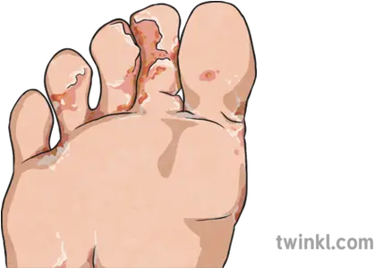 Athletes Foot Illustration Foot Png Foot Png