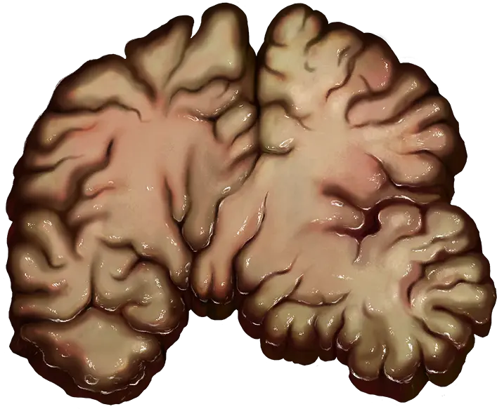 Brain Official Pathologic Wiki Brain Png Brain Png