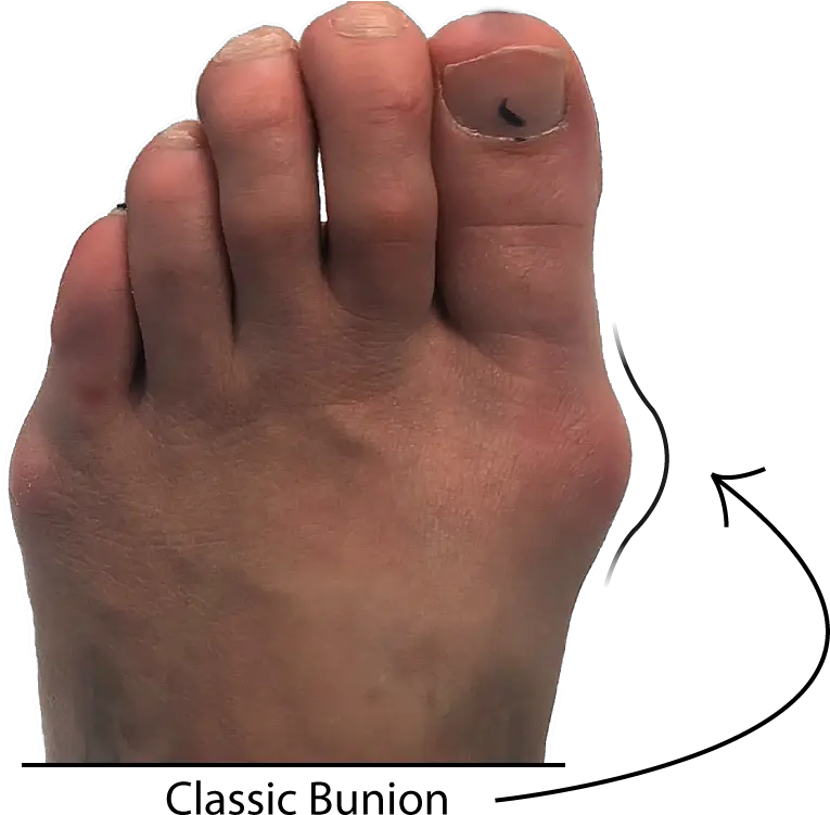 Bunion Symptom Checker Toe Png Toe Png