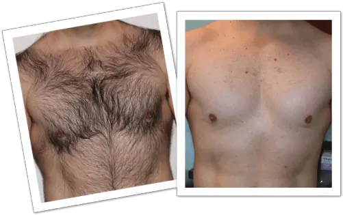 Laser Hair Removal Men Chest Hair Removal Spray Png Chest Hair Png