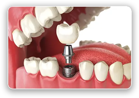 Expert Dental Implants In Ewa Beach Hi Laulani Care Implante Dental Png Tooth Png