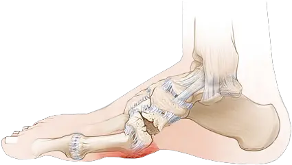 Chacot Foot Symptoms U0026 Treatment Florida Ankle Ankle Png Foot Png