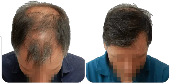 Fue Hair Transplant Procedure Advantages And Cost By Fue Hair Transplant Results Png Long Hair Transparent